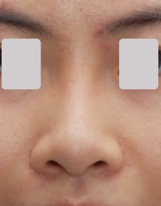 Rhinoplasty Before & After Gallery - Patient 324027 - Image 2
