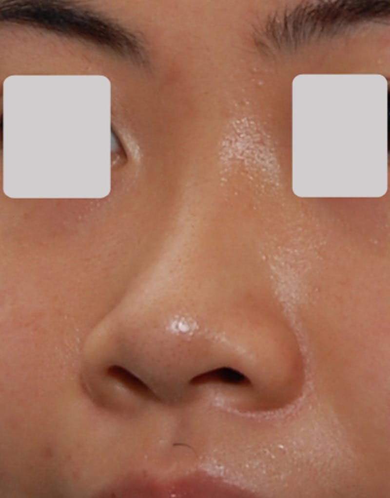 Rhinoplasty Before & After Gallery - Patient 320193 - Image 3