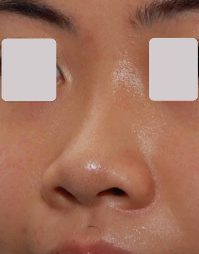 Rhinoplasty  Before & After Gallery - Patient 324027 - Image 3