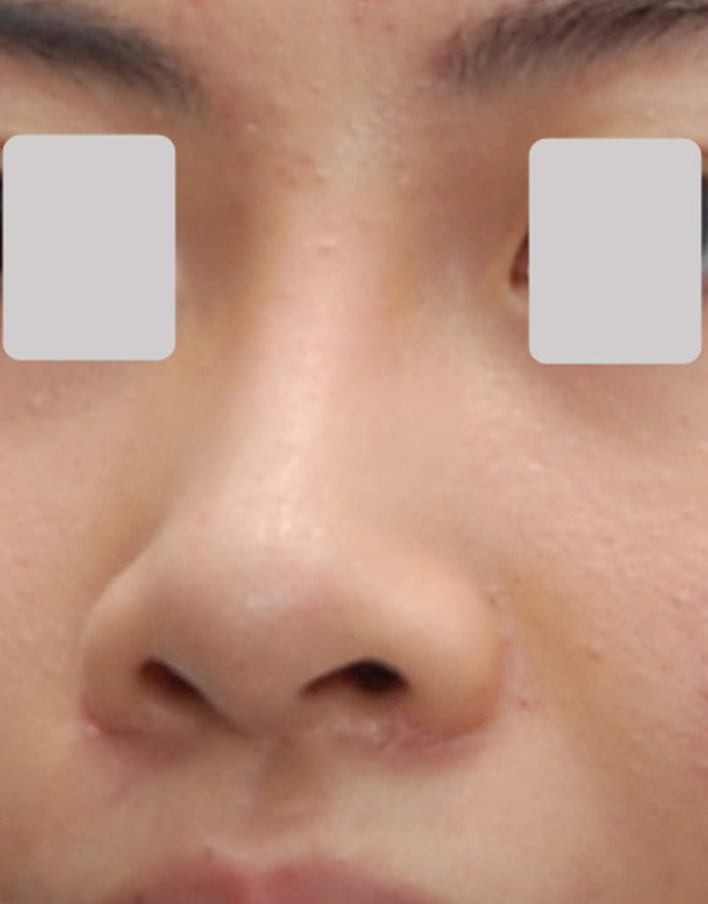 Rhinoplasty Before & After Gallery - Patient 320193 - Image 4