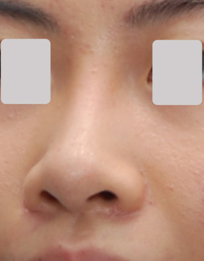 Rhinoplasty  Before & After Gallery - Patient 324027 - Image 4