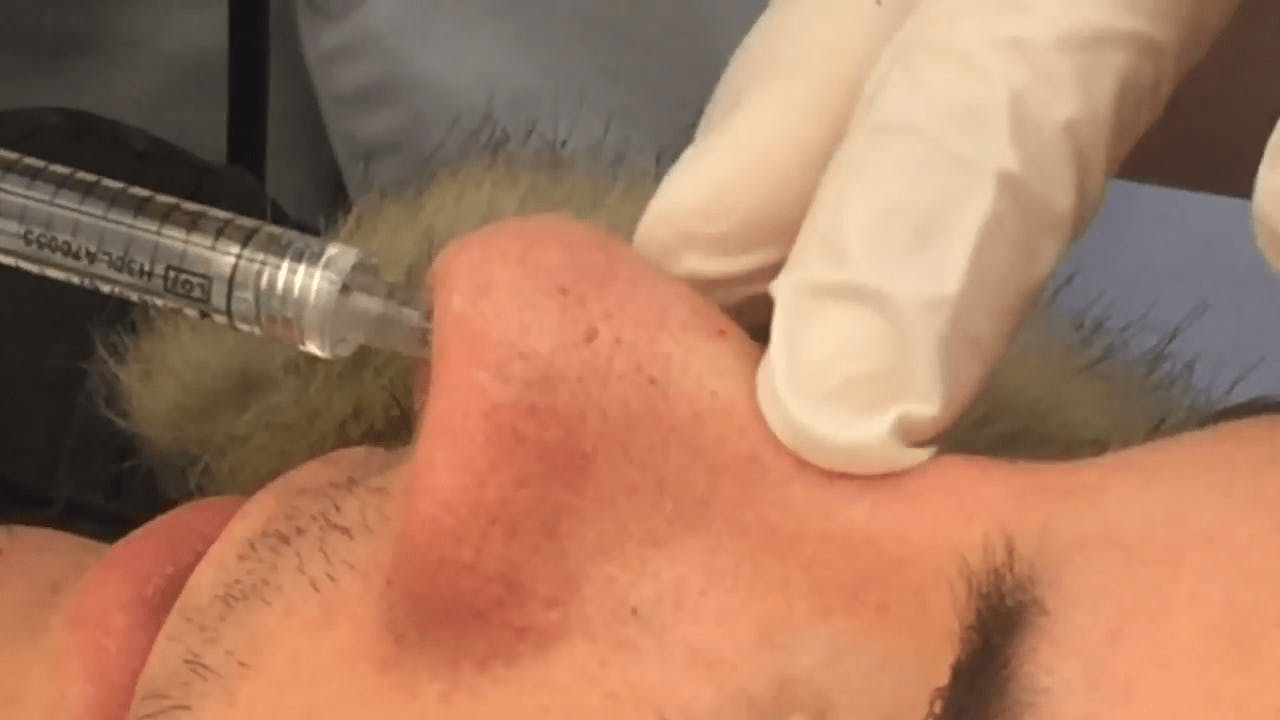 person getting an injection in his nose