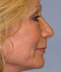 neck lift patient