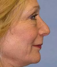 neck lift patient