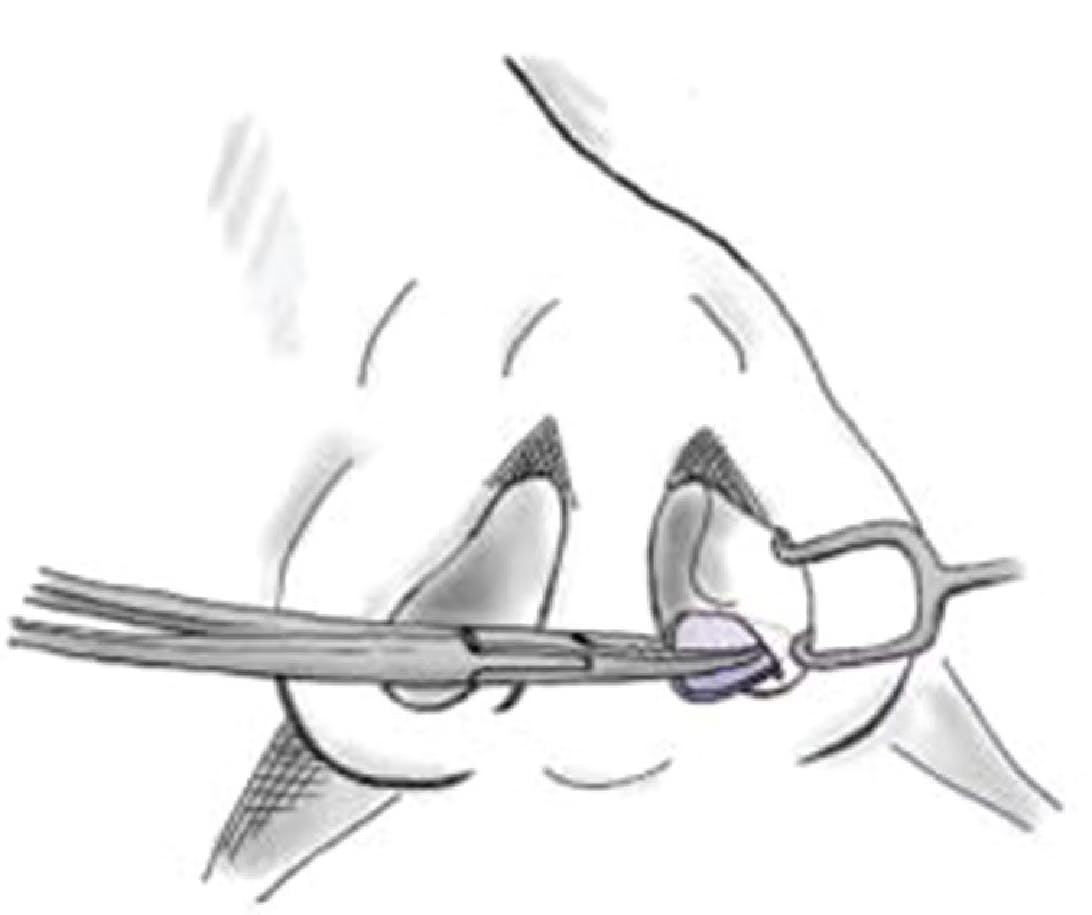 The Subalar Graft and Its Role in Nasal Tip Medialization and Improved Nostril Symmetry (2013)