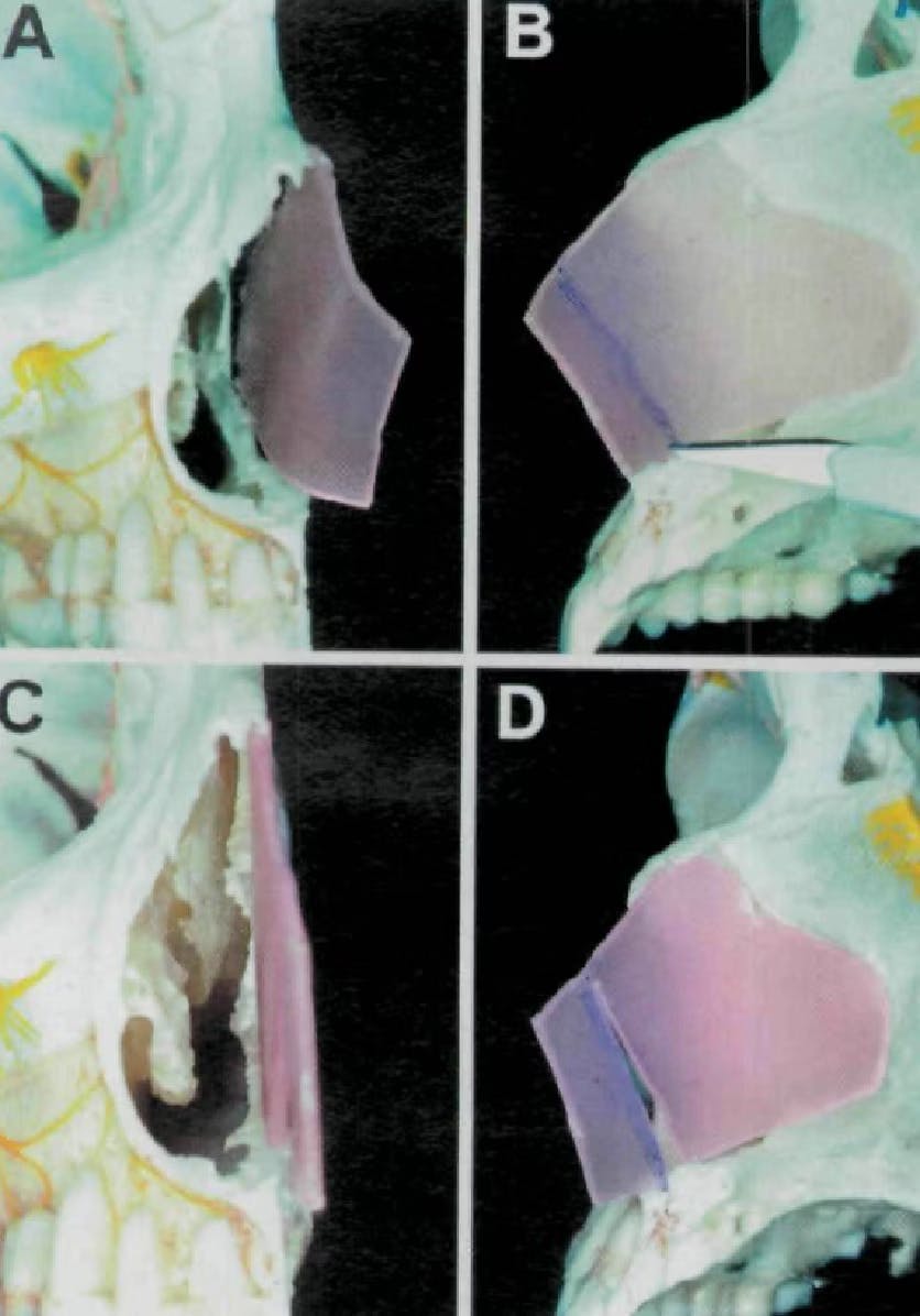Correction of caudal deflections of the nasal septum with a modified Goldman septoplasty technique: how we do it (2007)