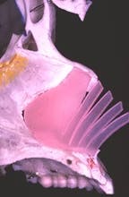 Fan septoplasty for correction of the internally and externally deviated nose (2006)