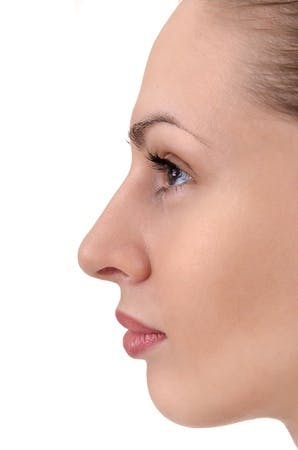 Photo after Rhinoplasty