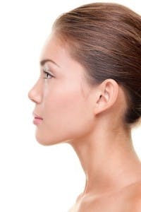 Female patient after Rhinoplasty procedure - photo