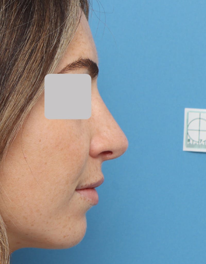 Rhinoplasty Before & After Gallery - Patient 718023 - Image 2