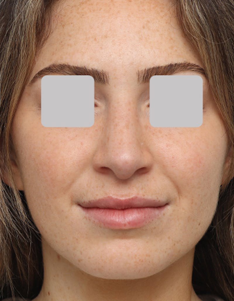 Favorite Rhinoplasty Before & After Gallery - Patient 305970 - Image 4