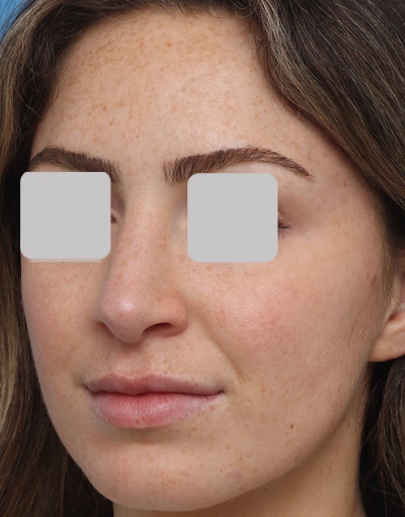 Rhinoplasty Before & After Gallery - Patient 718023 - Image 6