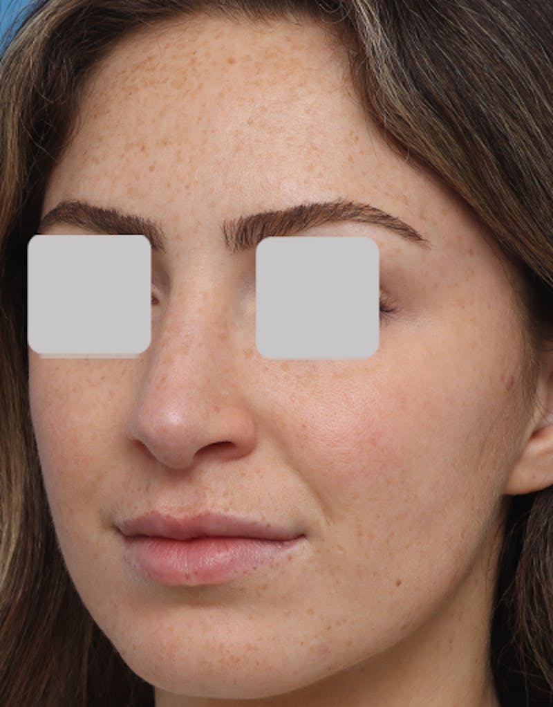 Favorite Rhinoplasty Before & After Gallery - Patient 305970 - Image 6