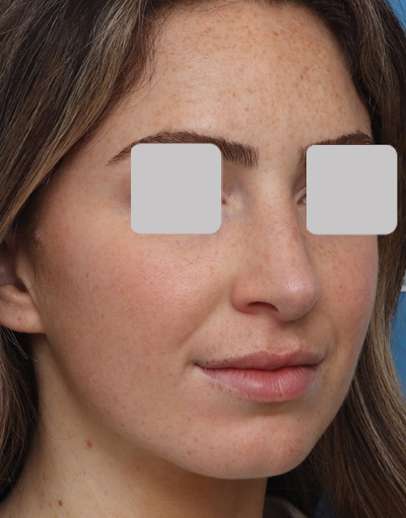Favorite Rhinoplasty Before & After Gallery - Patient 305970 - Image 8