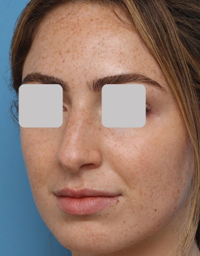 Rhinoplasty Before & After Gallery - Patient 718023 - Image 5
