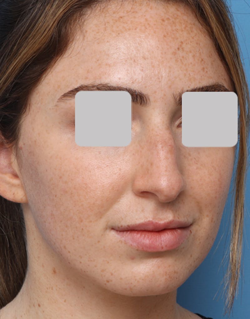 Favorite Rhinoplasty Before & After Gallery - Patient 305970 - Image 7