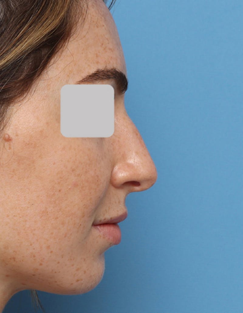 Rhinoplasty Before & After Gallery - Patient 718023 - Image 1