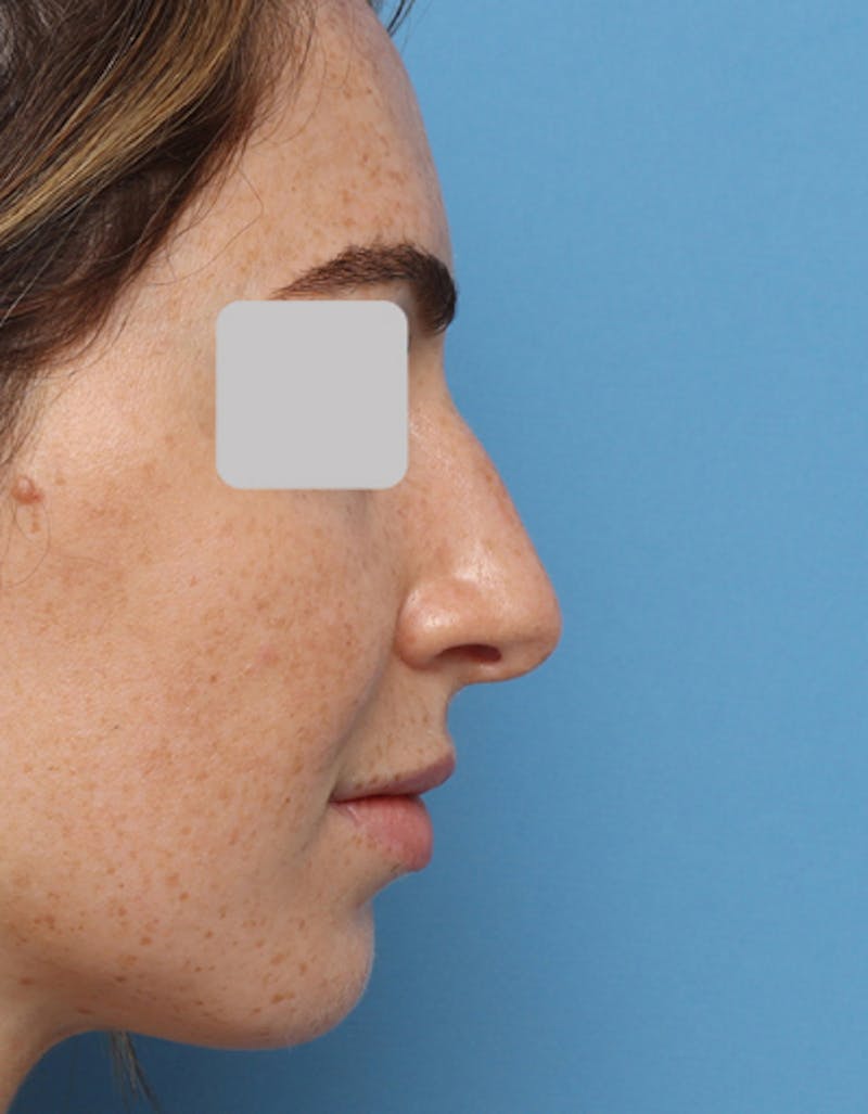 Patient Pj3kiHrCQ2WmorsGirJv5g - Rhinoplasty Before & After Photos