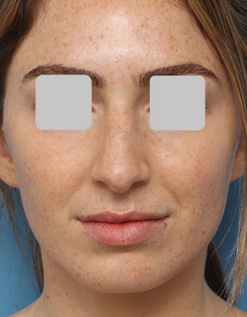Rhinoplasty Before & After Gallery - Patient 718023 - Image 3