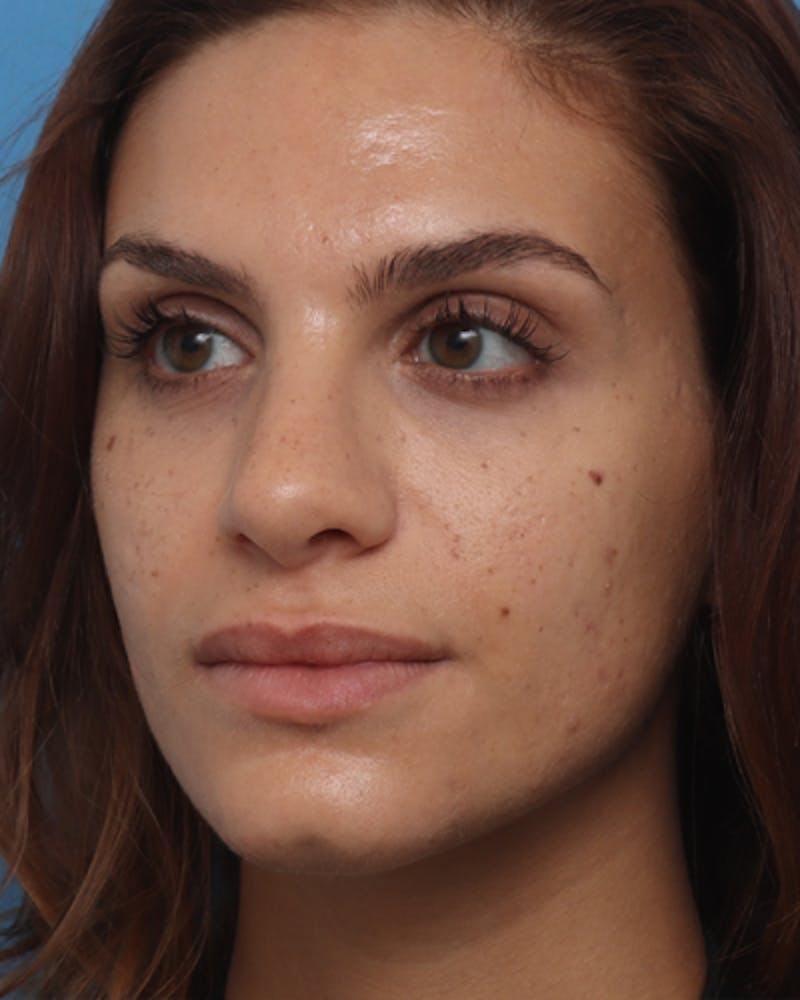 Rhinoplasty Before & After Gallery - Patient 224019 - Image 4