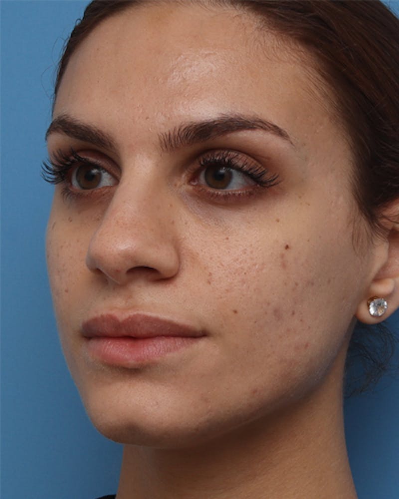 Rhinoplasty Before & After Gallery - Patient 224019 - Image 3