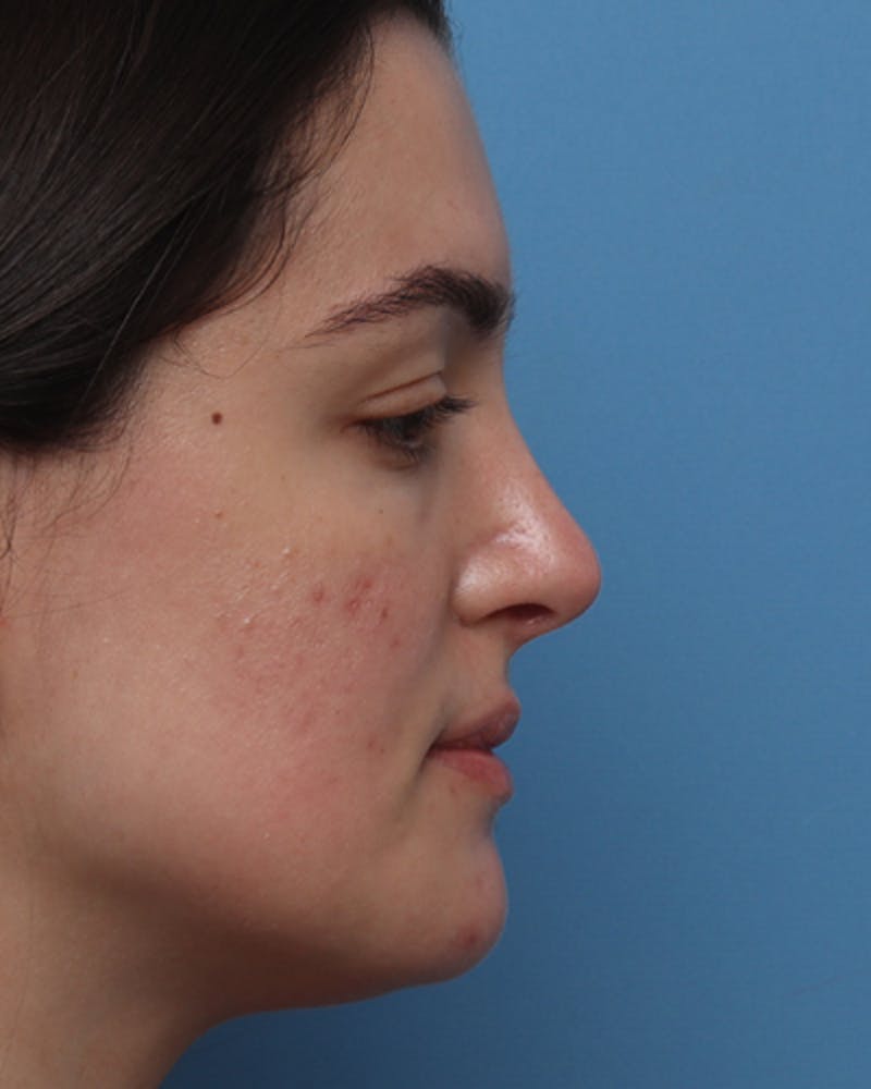 Rhinoplasty Before & After Gallery - Patient 400058 - Image 2