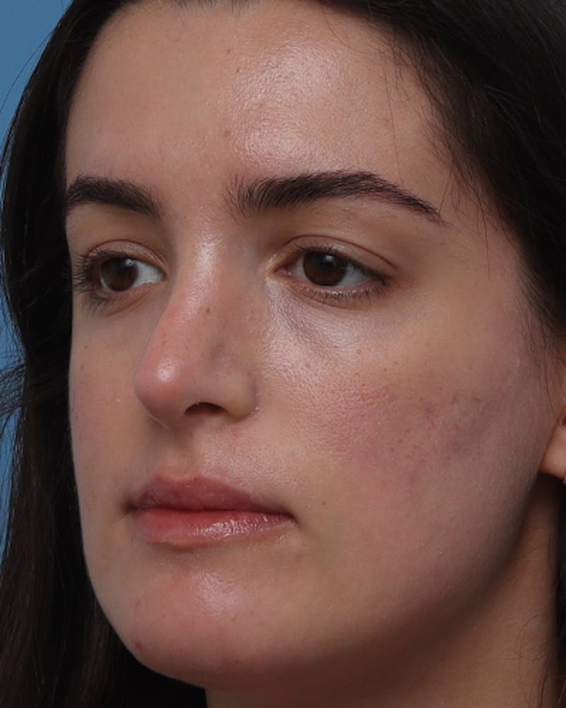 Rhinoplasty Before & After Gallery - Patient 400058 - Image 6