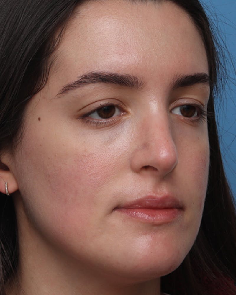 Rhinoplasty Before & After Gallery - Patient 400058 - Image 8