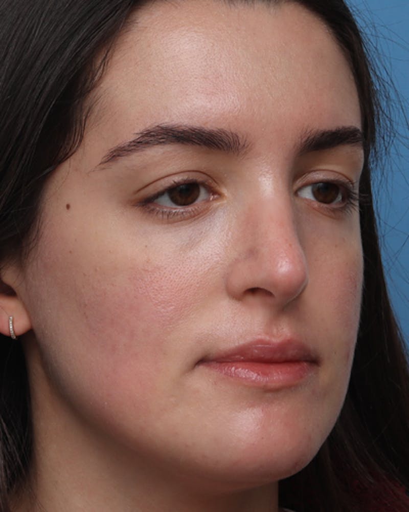 Rhinoplasty  Before & After Gallery - Patient 411546 - Image 8
