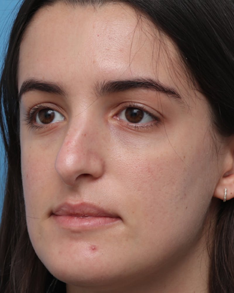 Rhinoplasty Before & After Gallery - Patient 400058 - Image 5
