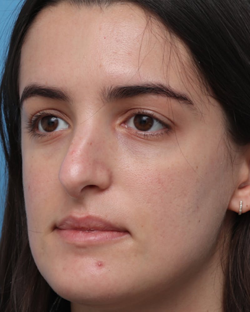 Rhinoplasty  Before & After Gallery - Patient 411546 - Image 5