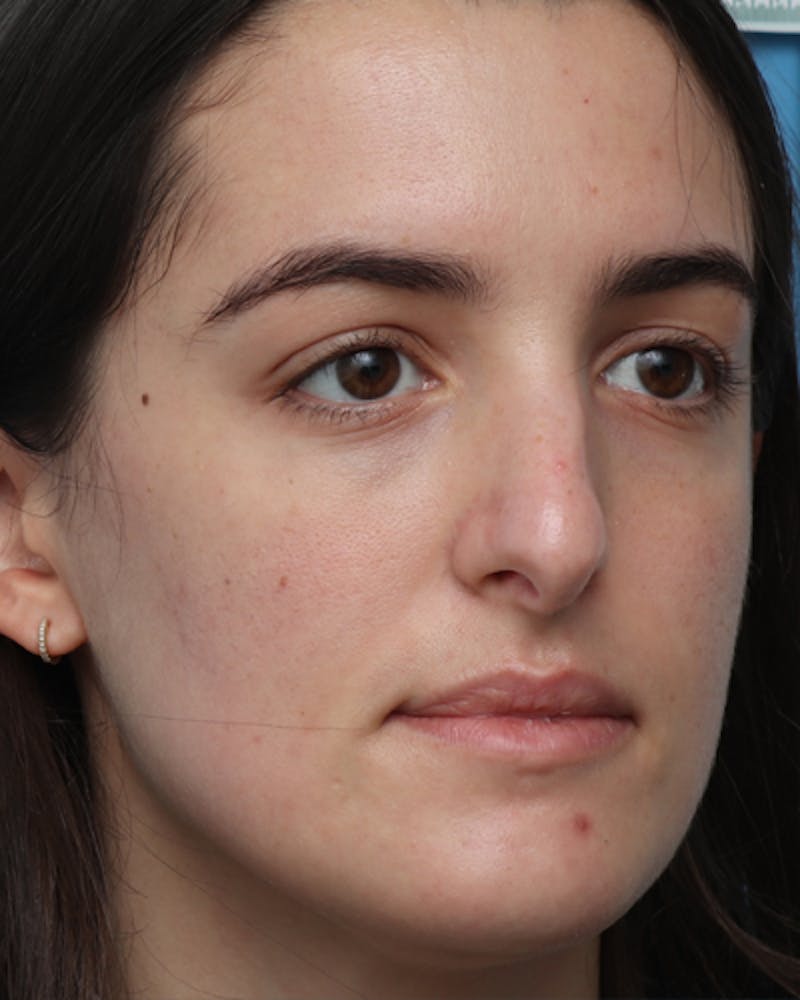 Rhinoplasty Before & After Gallery - Patient 400058 - Image 7