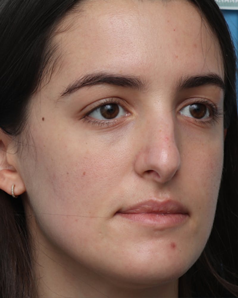 Rhinoplasty  Before & After Gallery - Patient 411546 - Image 7