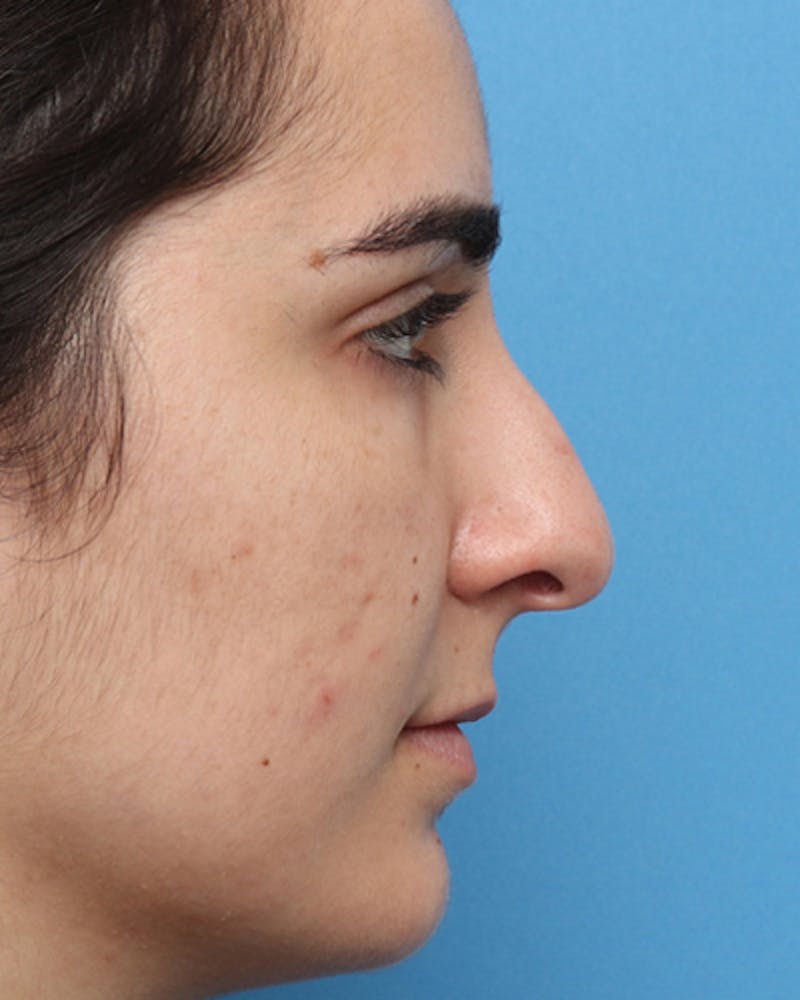 Rhinoplasty Before & After Gallery - Patient 136889 - Image 5
