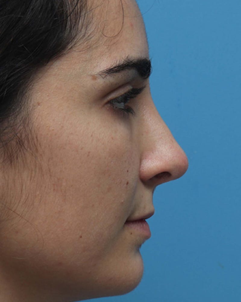 Rhinoplasty Before & After Gallery - Patient 136889 - Image 6