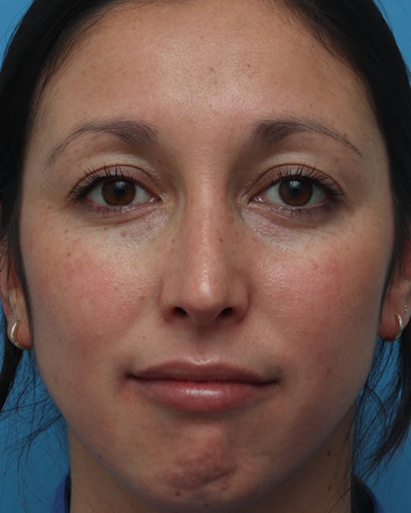 Rhinoplasty Before & After Gallery - Patient 387927 - Image 4