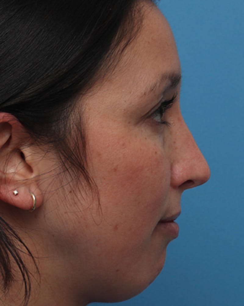 Rhinoplasty Before & After Gallery - Patient 387927 - Image 2