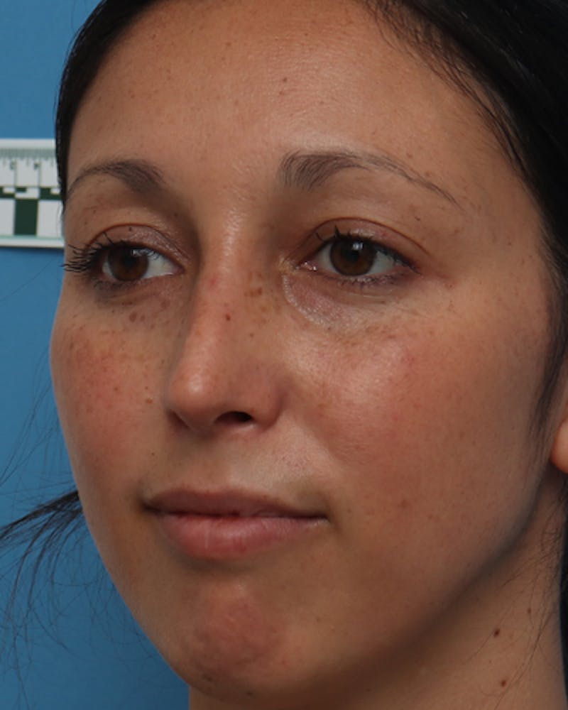 Rhinoplasty Before & After Gallery - Patient 387927 - Image 6