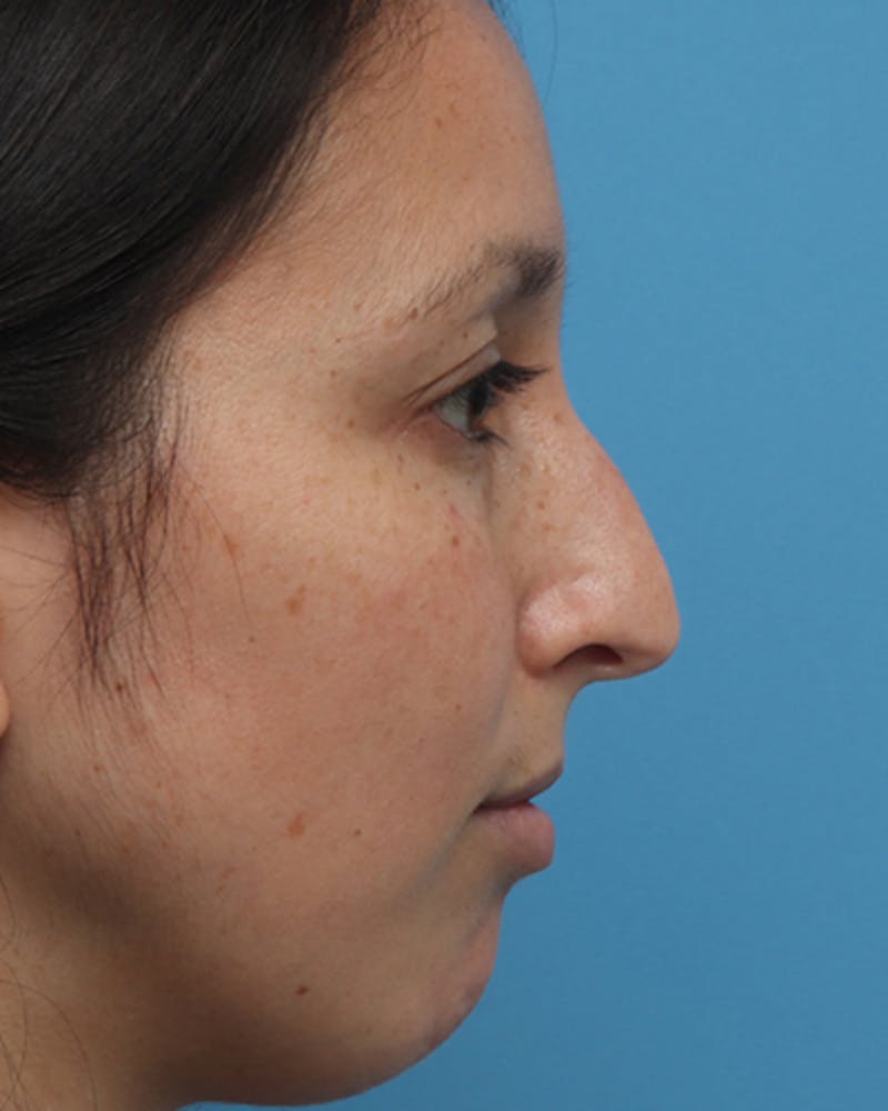 Patient Mudd3BDlRC2GedKlLUza5g - Rhinoplasty Before & After Photos