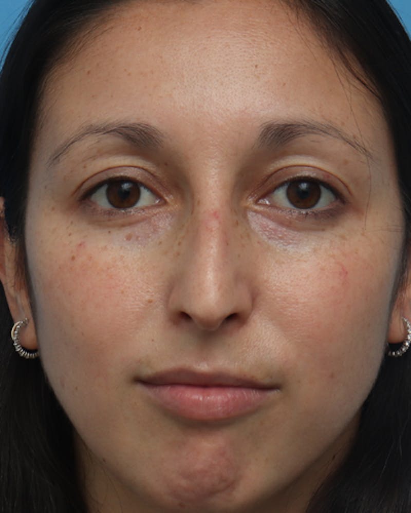 Rhinoplasty Before & After Gallery - Patient 387927 - Image 3