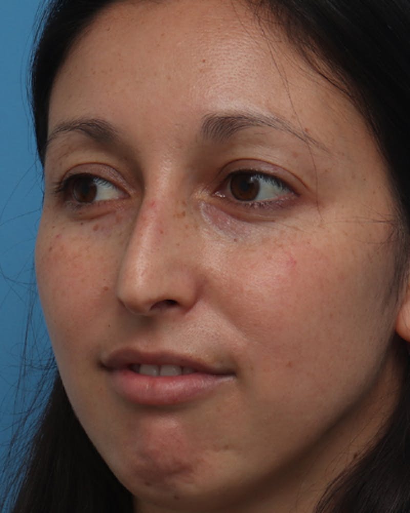 Rhinoplasty Before & After Gallery - Patient 387927 - Image 5