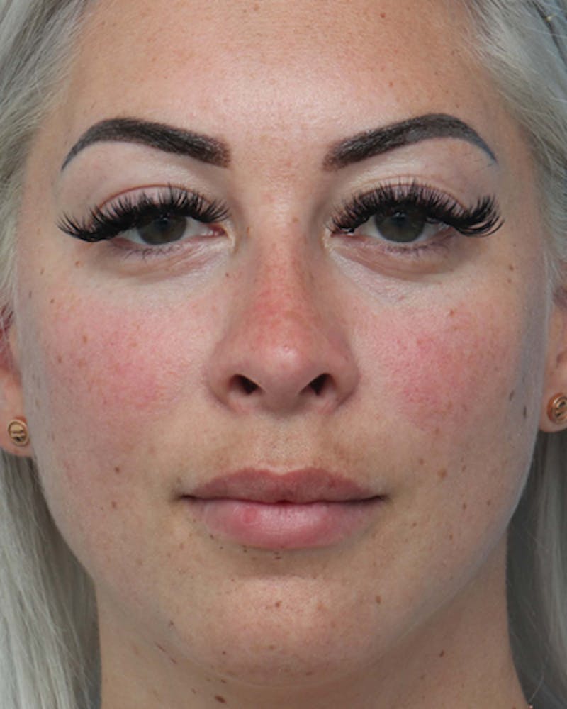 Rhinoplasty Before & After Gallery - Patient 255143 - Image 1