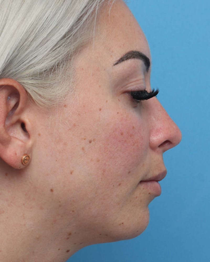 Rhinoplasty Before & After Gallery - Patient 255143 - Image 2