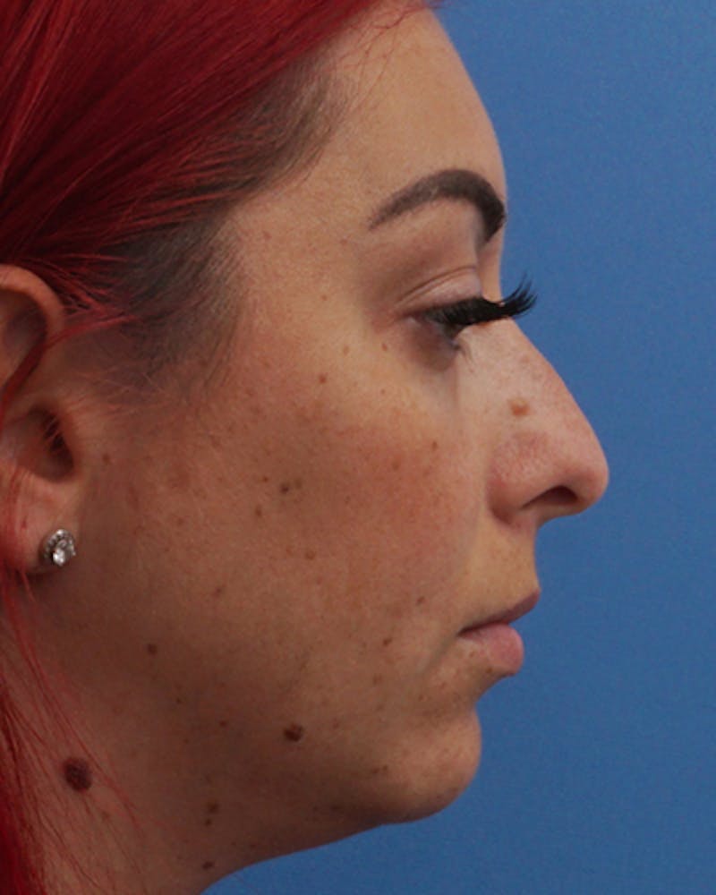 Rhinoplasty Before & After Gallery - Patient 255143 - Image 3
