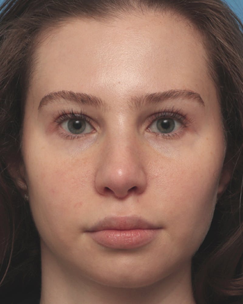 Rhinoplasty Before & After Gallery - Patient 330443 - Image 4