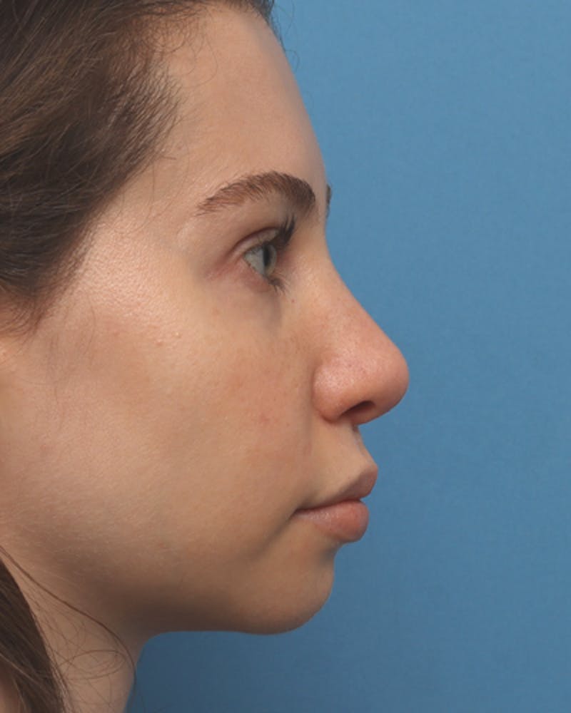 Rhinoplasty Before & After Gallery - Patient 330443 - Image 2