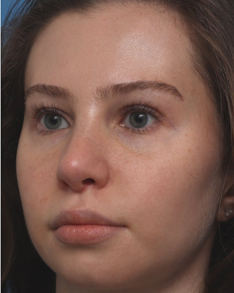 Rhinoplasty Before & After Gallery - Patient 330443 - Image 5
