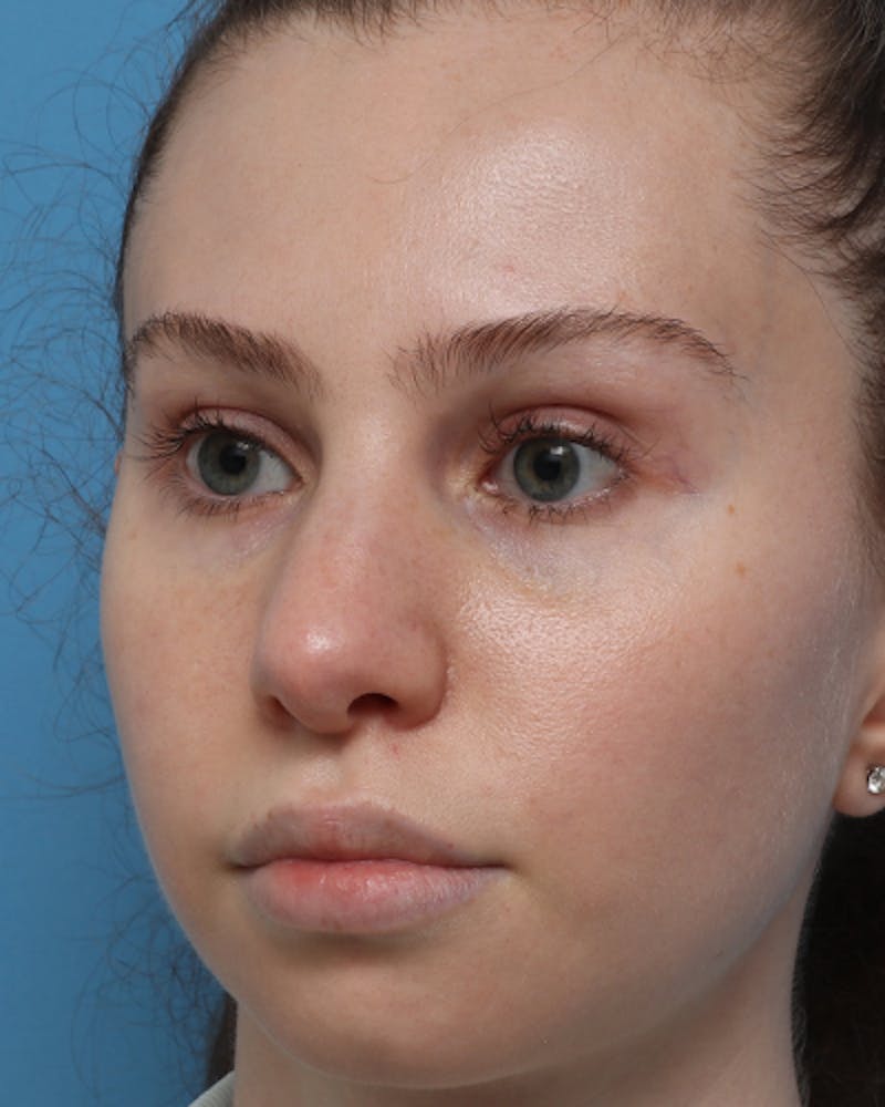 Rhinoplasty Before & After Gallery - Patient 330443 - Image 6