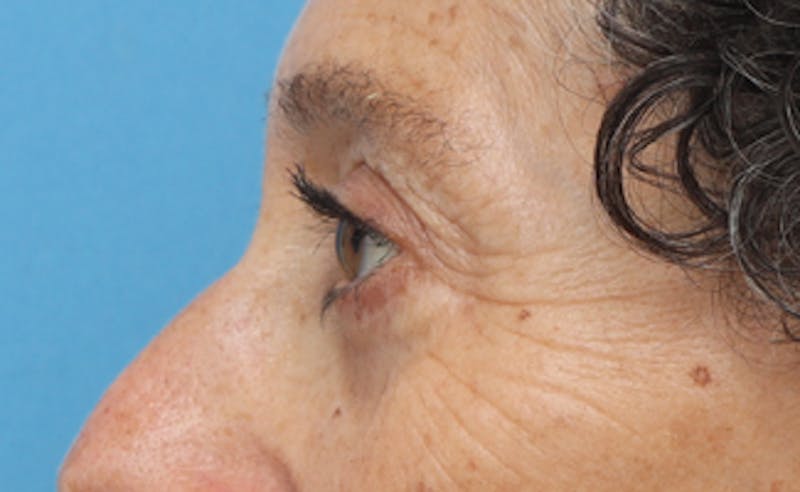 Eyelid Surgery Before & After Gallery - Patient 303461 - Image 8