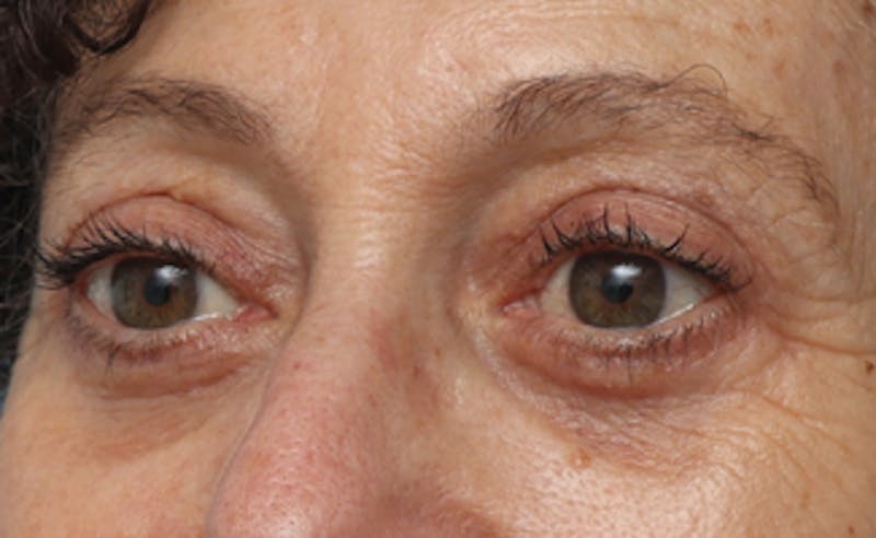 Eyelid Surgery Before & After Gallery - Patient 303461 - Image 4